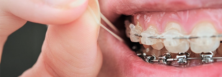 Orthodontics in Monsey NY