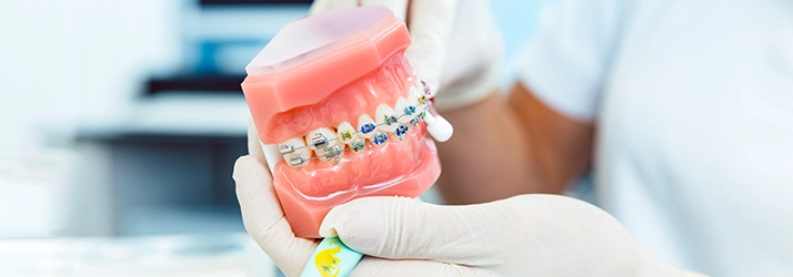 Types Of Braces in Monsey NY
