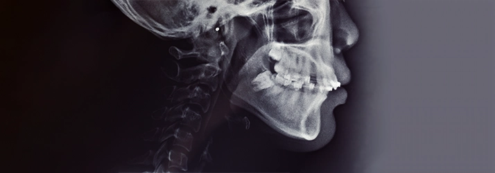 Orthognathic Surgery in Monsey NY